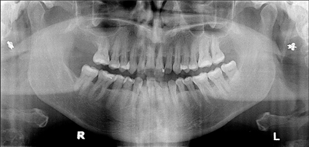 Pre-op 2D panoramic displays generalized horizontal bone loss and localized vertical bone loss. Multiple tooth mobility were at the maxillary, for a total of eight teeth (no. 14, 15, 12, 21, 22, 16, 26 and 27). Multiple furcation exposure, inter dental spaces and food retention were also observed.