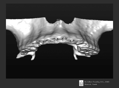 CBCT scan of patient’s maxilla with virtual teeth extraction. One can observe the bone resorption morphology from periodontitis condition.
