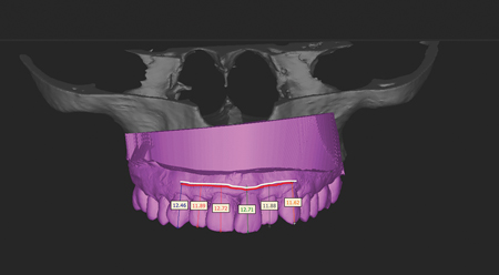 On the previous measurements of the scan superposition, a white line is draw to connect the dotes. Another line (red) is draw 2 mm incisor to the bone crest line. That 2 mm space between the lines reproduces the thickness of the soft tissue after teeth extraction. A vacushell was prepared and trim to this red line.