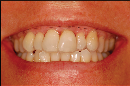 A vacushell was made on the study cast and trimmed to the CBCT data. The vacushell upper limitation represents thepredicted soft tissue profile (transitional line). The patient was ask to smile and talk with this vacucshell to visualize thepredicted soft tissue transitional line. Soft tissue is exposed beyond the vacushell gingival aspect, this depicts a predictable gummy smile result after surgery.