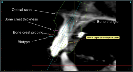 An optical scan of the study cast is superimposed on a CBCT scan. One must note that an optical scan will give a 40 microns precision for the impression.