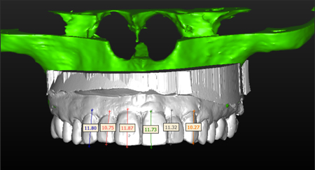 A diagnostic wax up is prepared with the directive of reducing the verticalmaxillary excess by closing down the VDO. This will allow to contour the bone crest with osteoplasty and locate it more apically.