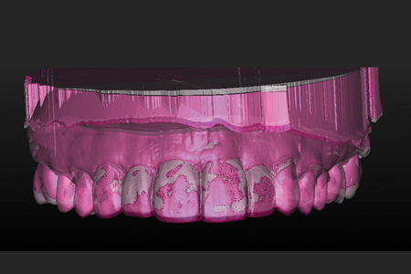 A superposition of the original diagnostic cast on the final wax-up depicts the modifications in the teeth positions. Redbeing the original diagnostic cast and white being the proposed diagnostic wax.