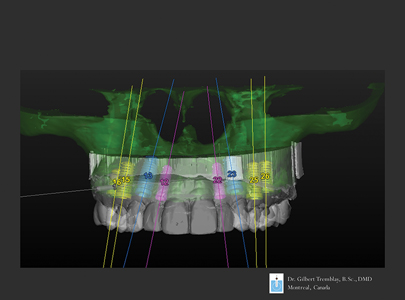 Implant planning is completed with the teeth diagnostic wax-up. Transparencyof the CBCT superimposed on the optical scan allows a reversed engineering process of implant positioning.