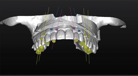 An occlusal 3D view of the planned implants positions in relation to the diagnostic wax-up, depicts the emergence profile of the implants exit position on the teeth.