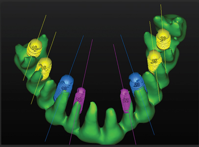 Posterior implants are located in the root furcation. This will allow a maximum anchorage of the implant for an optimal primary fixation.