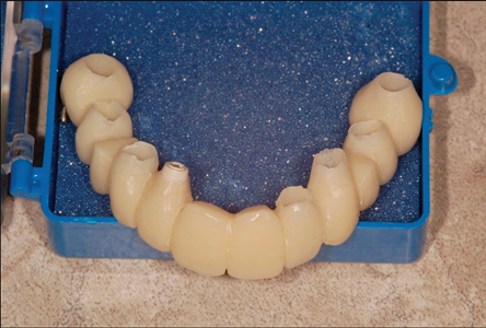 A one-piece acrylic immediate fixe prosthesis was prepared on the implant abutments.