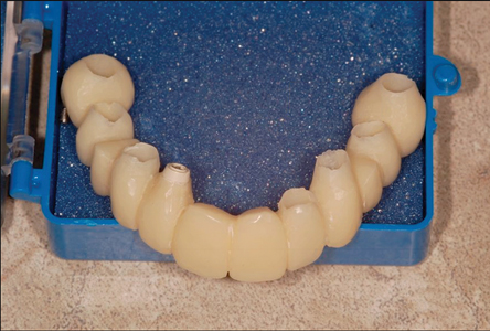 A one-piece acrylic immediate fixe prosthesis was prepared on the implant abutments.