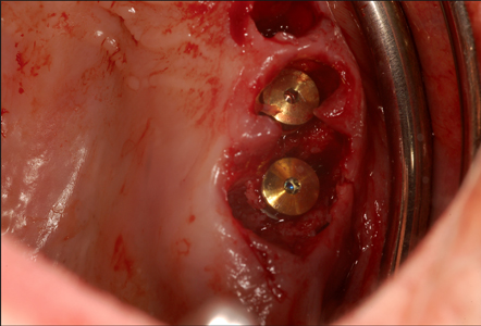 High precision implant insertion is achieved with computer-guided surgery. Flapless surgery and implants are inserted in the bone furcation without any deviation,hence primary fixation is achieved and prosthetic matching was completed. This surgical precision cannot be achieved with free hand surgery.