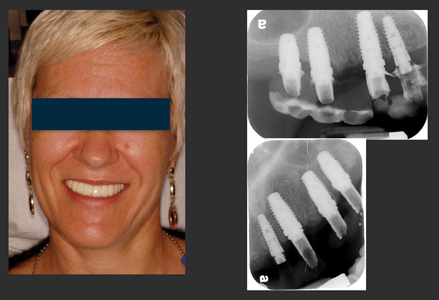 Immediate temporary fixed prosthesis. Six-months post-op radiograph.