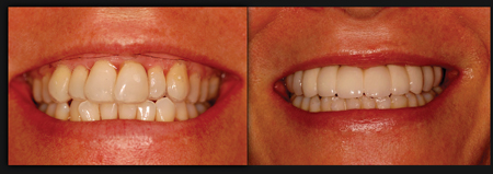 Before and after photograph. Final prosthesis is a zirconia to porcelain cemented restoration. Notice, as predicted, correction of vertical maxillary excess and positioning of the final transitional line under the superior lip.