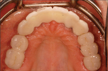 Occlusal view. Notice implant emergence profile in conjunction with the final prosthetic design.