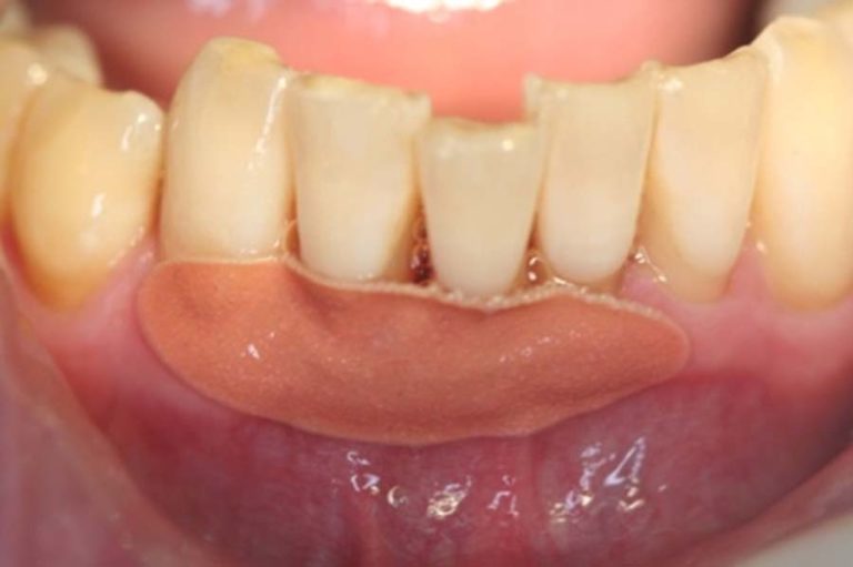 Empowering Periodontal Therapy - Oral Health Group