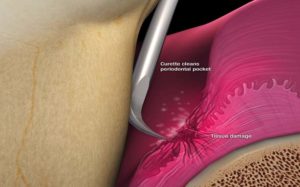 Scaling and curettage cleaning the infected pocket