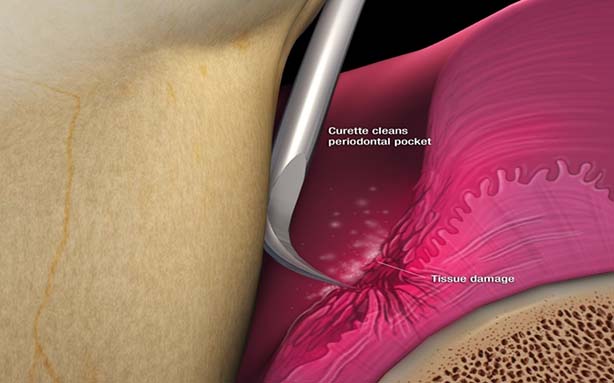 Periactive Rinse Empowering Periodontal Therapy - Oral Health Group