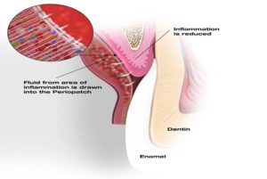 Inflammation is reduced and healing fibroblast cells are depositing collagen