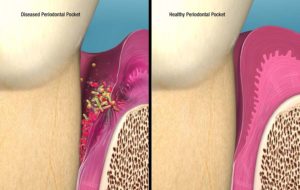 Infected pocket vs. Healthy pocket post treatment