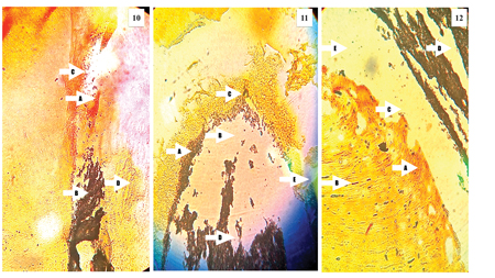 Representative histological images of teeth evaluated in this study demonstrating the possible causes of failure of treatment. The description can be found in the results section.