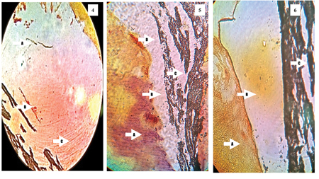 Representative histological images of teeth evaluated in this study demonstrating the possible causes of failure of treatment. The description can be found in the results section.