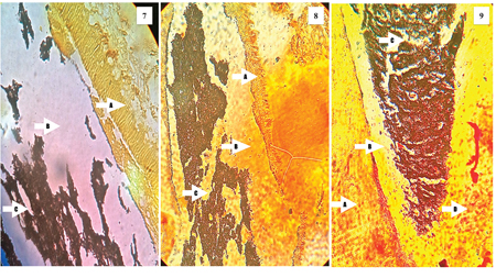 Representative histological images of teeth evaluated in this study demonstrating the possible causes of failure of treatment. The description can be found in the results section.