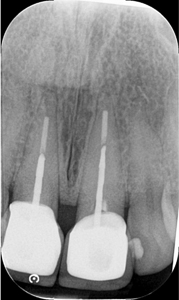 Initial periapical radiograph.