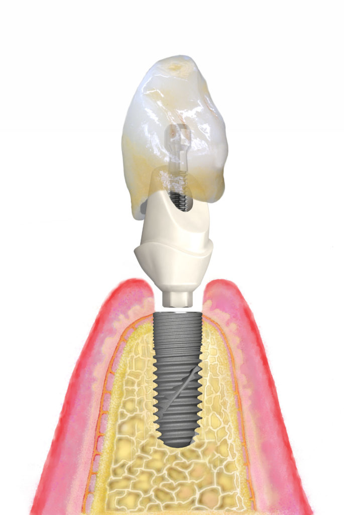 171116 Bild_PI_Umstellung_Technikerschraube BEGO Implant ...
