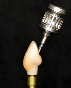 NobelProcera® Angulated Screw Channel crown. Note direction of fixture vs abutment screw.