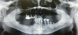 KC can be associated with cystic formation and/or transmigration. Transmigration is usually defined as a phenomenon in which more than half of the length of an unerupted tooth has passed the midline.