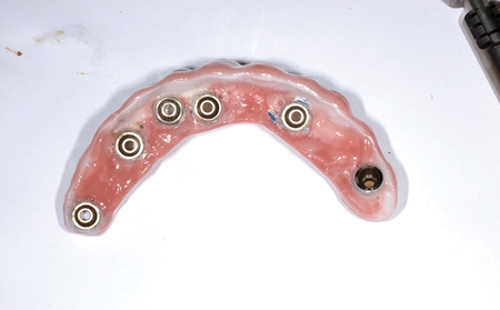 Implant Screw Fractures