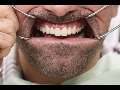 Mock-up with retractors (original photo is of the full face but was cropped to hide the patient's identity).