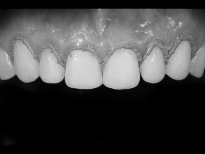 Preparations with retraction paste.