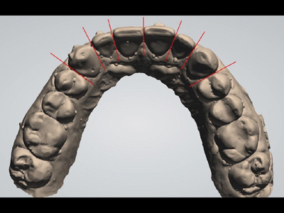 Initial maxillary arch.