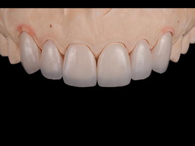 Feldspathic veneers on solid cast; frontal view.