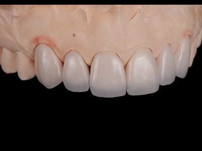 Feldspathic veneers on solid cast; right view.