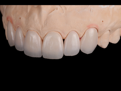 Feldspathic veneers on solid cast; left view.