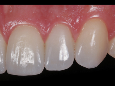 Intraoral right view.