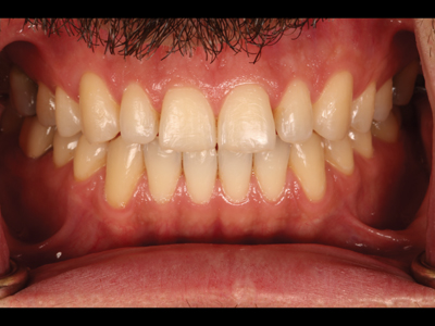 Frontal view after orthodontics.