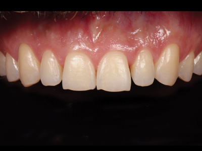 Intramural view of anterior teeth after orthodontics.