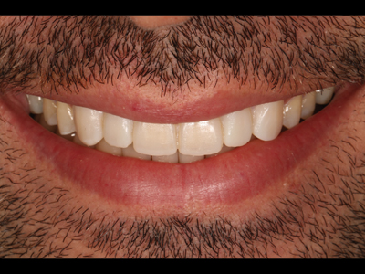 Close view of smile with mock-up.