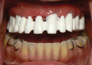 Final Fixed Prosthetic Options for Full Arch Implant Cases
