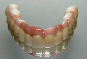 Final Fixed Prosthetic Options for Full Arch Implant Cases