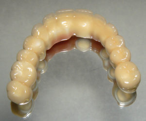 Final Fixed Prosthetic Options for Full Arch Implant Cases