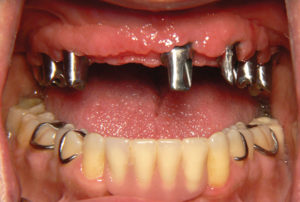 Final Fixed Prosthetic Options for Full Arch Implant Cases