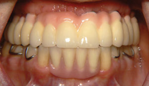 Final Fixed Prosthetic Options for Full Arch Implant Cases