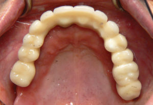 Final Fixed Prosthetic Options for Full Arch Implant Cases