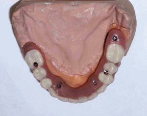 Final Fixed Prosthetic Options for Full Arch Implant Cases