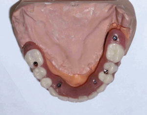  Final Fixed Prosthetic Options for Full Arch Implant Cases