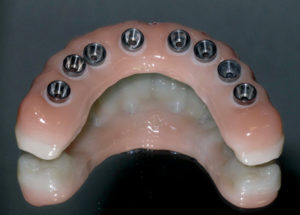 Final Fixed Prosthetic Options for Full Arch Implant Cases
