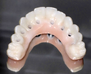 Final Fixed Prosthetic Options for Full Arch Implant Cases