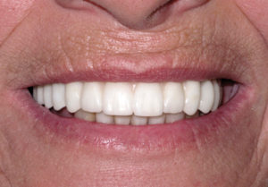 Final Fixed Prosthetic Options for Full Arch Implant Cases